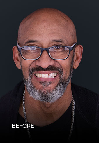Showing his smile before restoring his teeth with implant bridges in Mexico