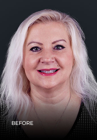 blonde patient beforer her dental treatment in mexico