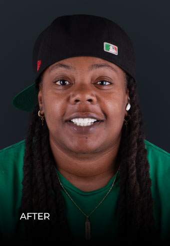 young patient after dental treatment in mexico