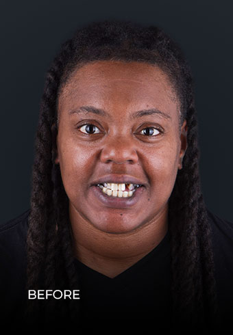 young patient before dental treatment in mexico