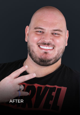 man after dental treatment in mexico