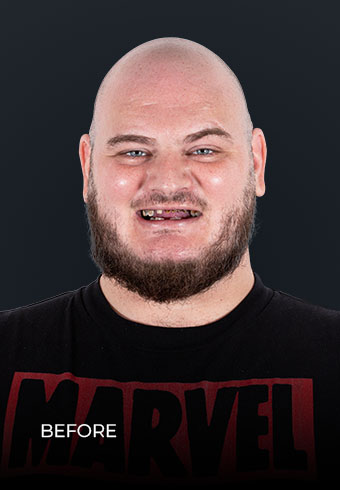 man before dental treatment in mexico