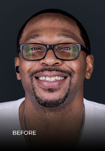 showing his smile before getting dental crowns and onlays in Mexico