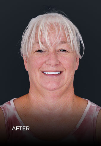 showing her smile after getting dental crowns and Inlays in Mexico