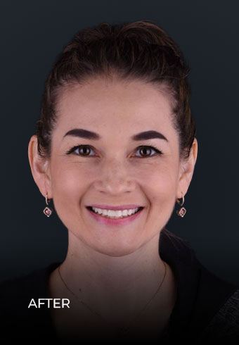 Patient showing her teeth after getting the Invisalign treatment in Mexico