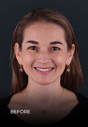 Patient showing her teeth before getting the Invisalign treatment in Mexico