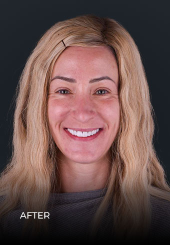 Patient showing her teeth after getting Invisalign clear aligners in Mexico