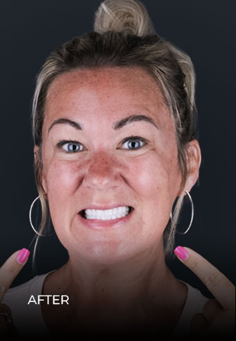 Patient showing her teeth after getting Invisalign braces in Mexico