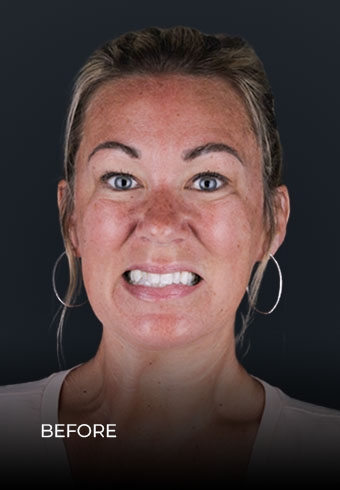 Patient showing her teeth before getting Invisalign braces in Mexico
