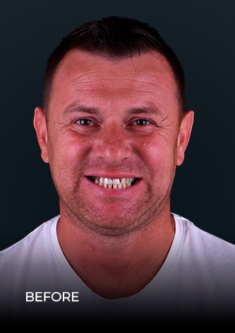 dental work mexico patient smiling before getting his crowns and bridges