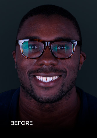 dental work mexico patient smiling before getting his same day crowns