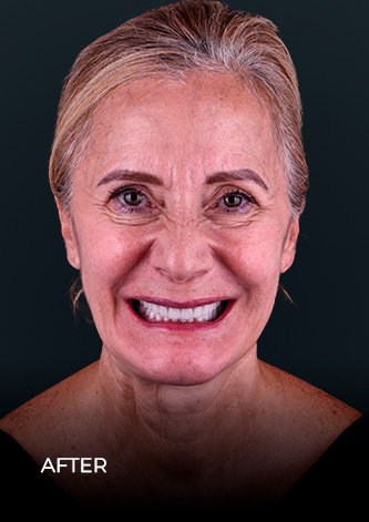 dental work mexico patient smiling after getting her emax crowns