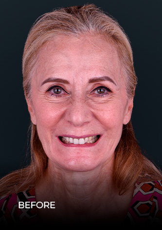 ental work mexico patient smiling before getting her emax crowns