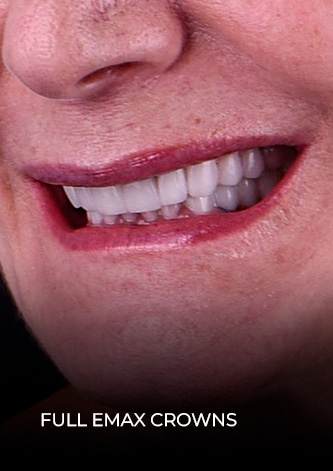 dental work mexico patient final restoration with emax porcelain crowns