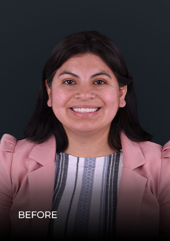 patient at ocean dental cancun before her teeth whintening session