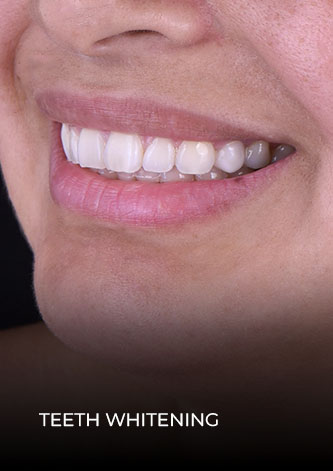 Close up after her teeth whitening treatment