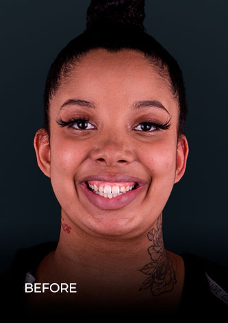 dental work mexico patient  smiling before getting her crowns
