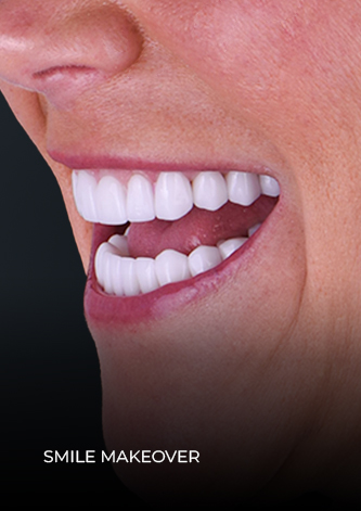 close-up shot of patient smile after getting her complete smile makeover in Cancun Mexico