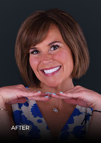 patient of Dental Work Mexico, smiling after her full smile makeover treatment