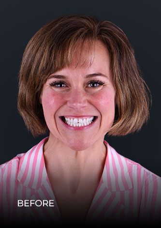 patient of Dental Work Mexico, smiling before her full smile makeover treatment