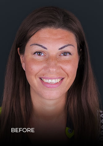 before getting composite veneers in Mexico