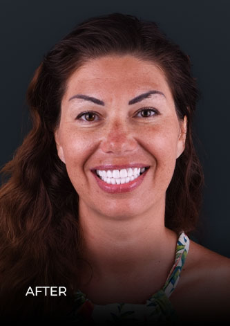 after getting composite veneers in Mexico