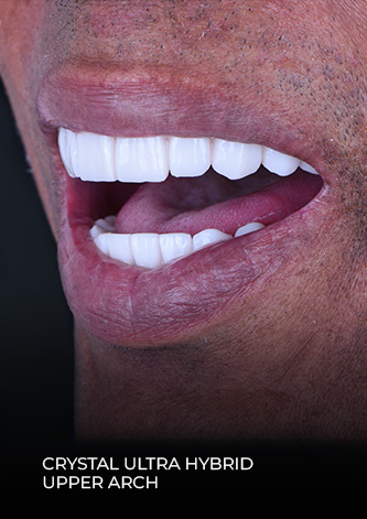 close up shot of patientsmile after his full mouth reconstruction in Mexiico