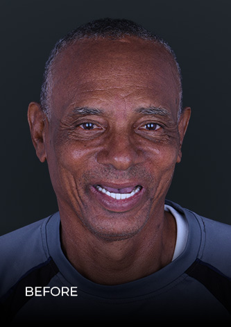 Patientafter getting a full-mouth reconstruction with dental implants in Mexico