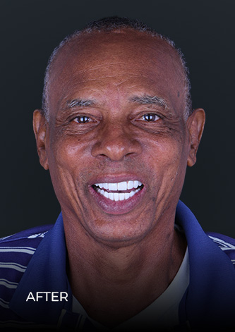 Patientbefore getting a full-mouth reconstruction with dental implants in Mexico