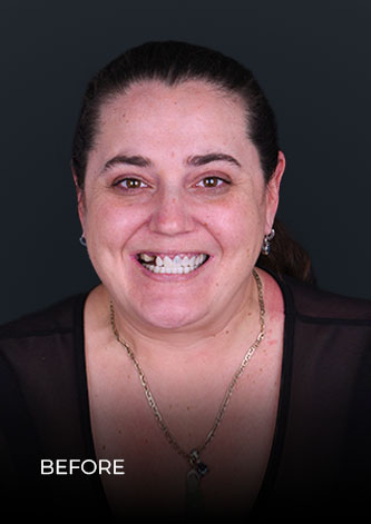 patient of Dental Work Mexico, smiling before her full-mouth restoration with crowns and bridges