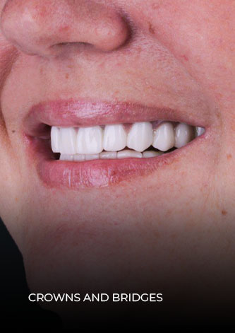 Close-up shot smile after getting crowns and bridges in Mexico