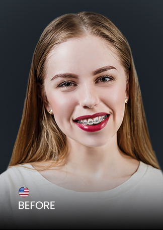 Ocean Dental Cancun patient before getting braces in Mexico