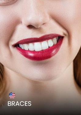 close-up shot of patient smile after getting braces and a full smile makeover at Ocean Dental Cancun