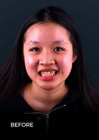 ocean dental cancun patient before getting dental crowns in Mexico