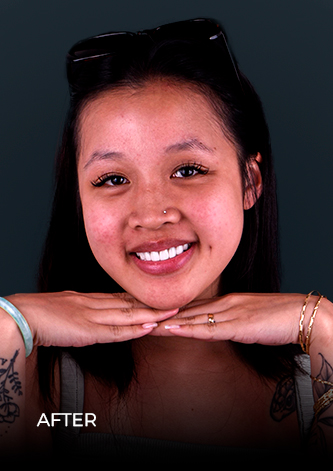 ocean dental cancun patient after getting dental crowns in Mexico