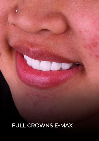 patient smile restored with Emax porcelain crowns in Mexico