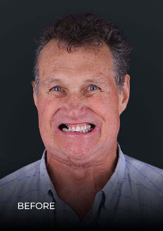 patient smiling before getting teeth implants in Cancun Mexico