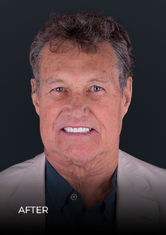 patient smiling after getting teeth implants in Cancun Mexico