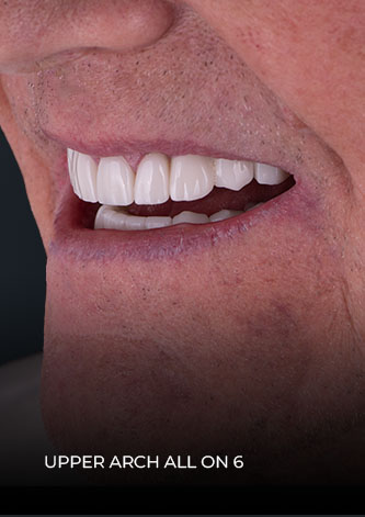 close-up to patient smile after his restoration with teeth implants