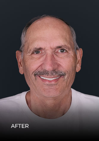 patient smiling after getting teeth implants in Mexico