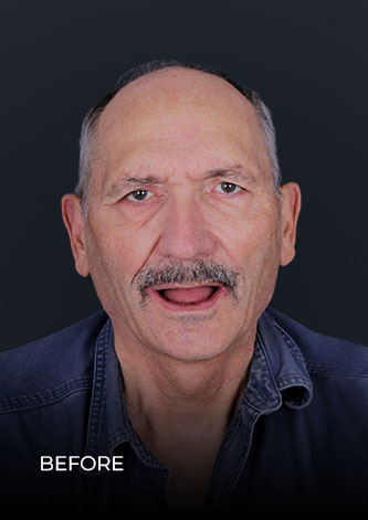 patient smiling before getting teeth implants in Mexico
