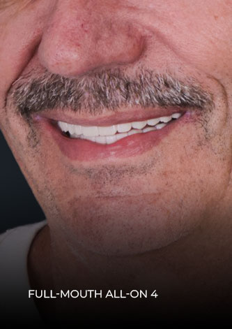 close-up to patient smile after his restoration with teeth implants in Mexico