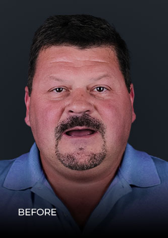 patient smiling before getting his full-arch reconstruction with dental implants in Mexico