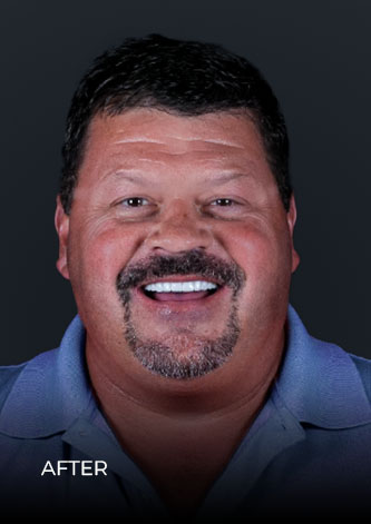 patient smiling after getting his full-arch reconstruction with dental implants in Mexico