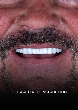 close up at patient smile with a full-arch dental restoration