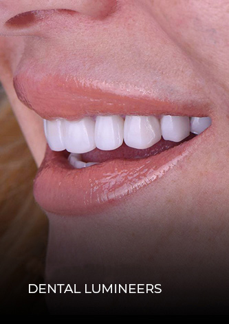 smile close up after getting lumineers in Mexico