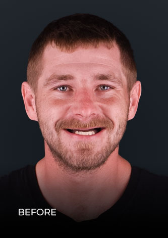 front shot of CDS patient before getting a full mouth reconstruction with crowns in Mexico