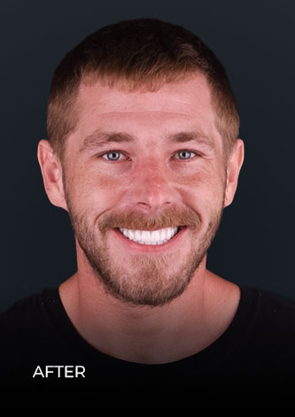 front shot of CDS patient after getting a full mouth reconstruction with crowns in Mexico