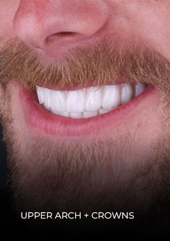 close-up shot of CDS patient, after getting a full mouth reconstruction with crowns in Mexico