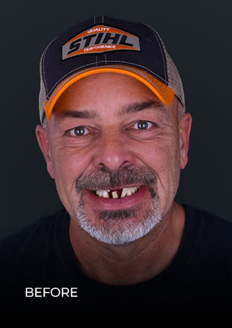 front shot of CDS patient, before getting All on 4 implants in Cancun